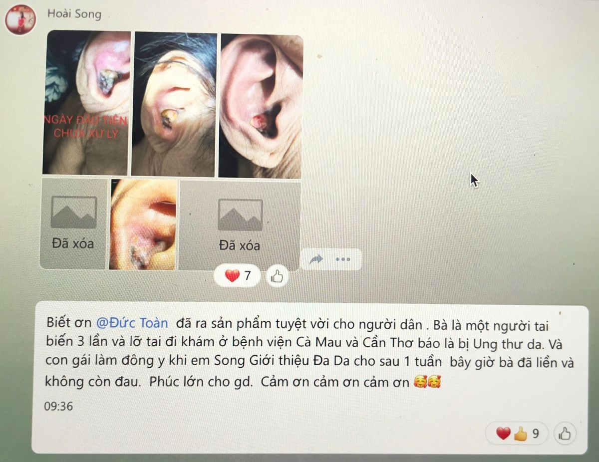 THUỐC BÔI ĐÔNG Y TOÀN MAI - XỬ LÝ VIÊM MÀNG TAI